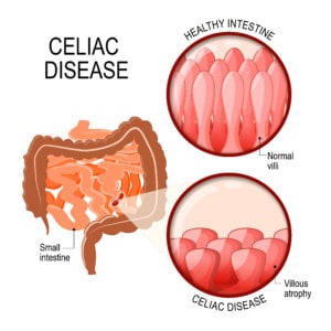 Celiac disease is another common digestive issues