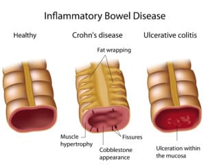 Crohn's disease is another common digestive disease