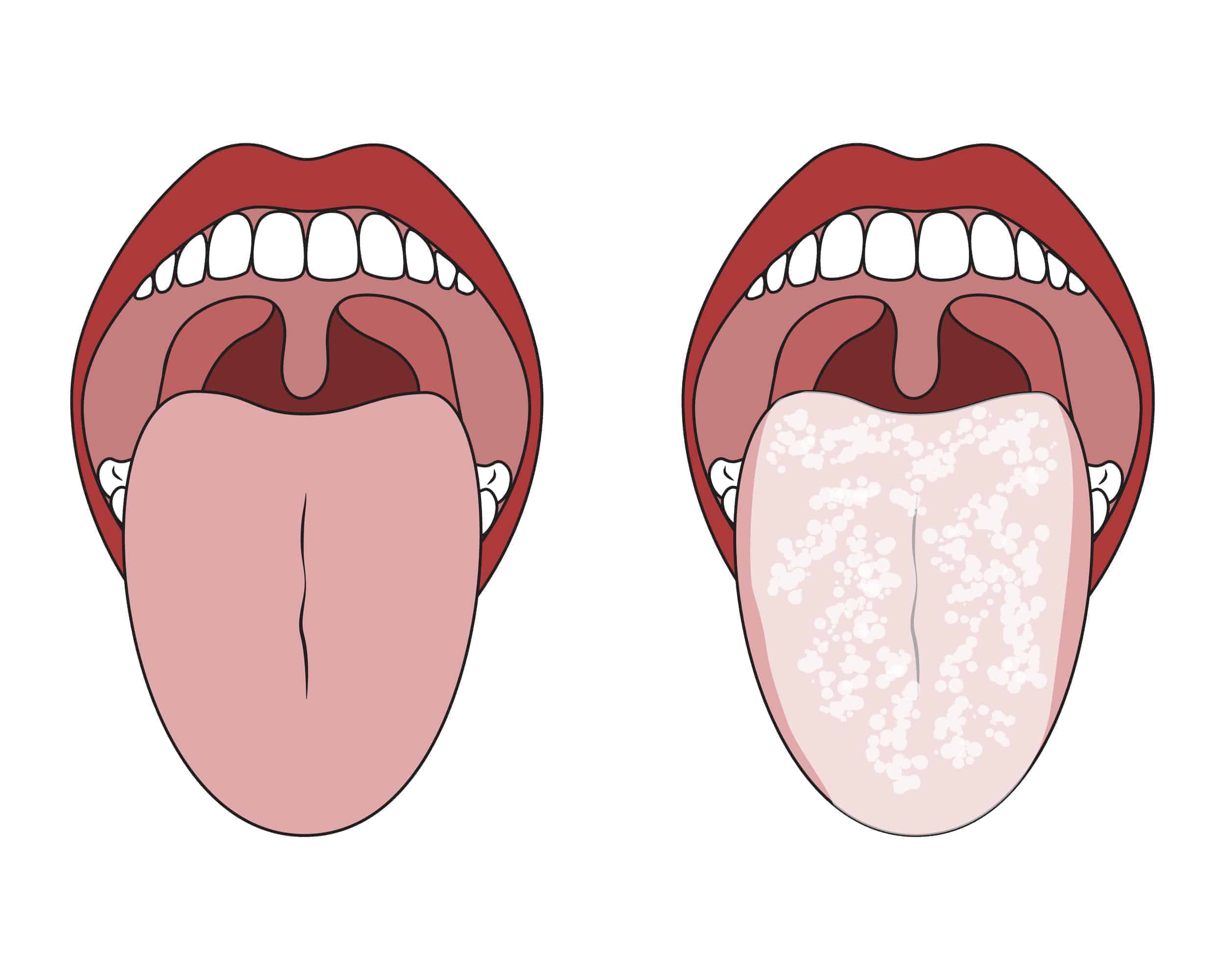 white swollen taste bud